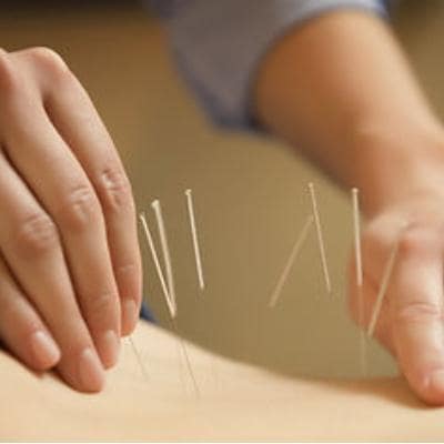 ACUPUNCTURE 